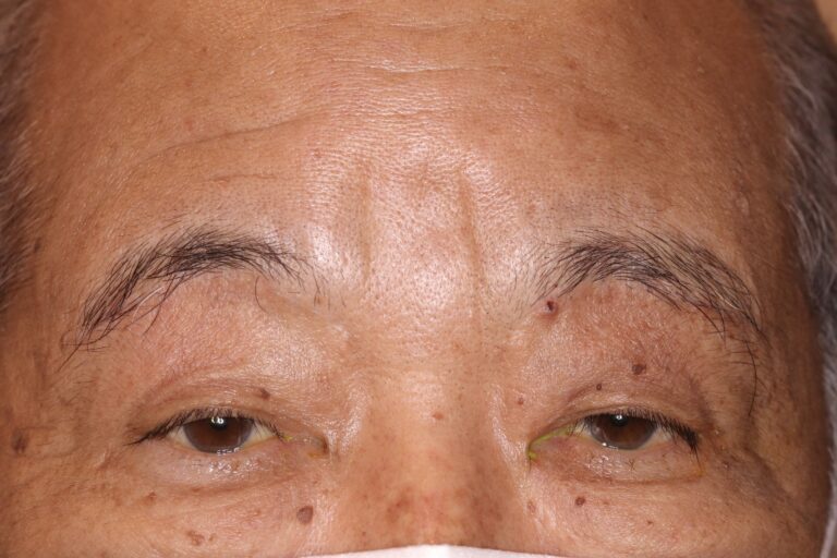 眼瞼下垂と眼瞼皮膚弛緩
