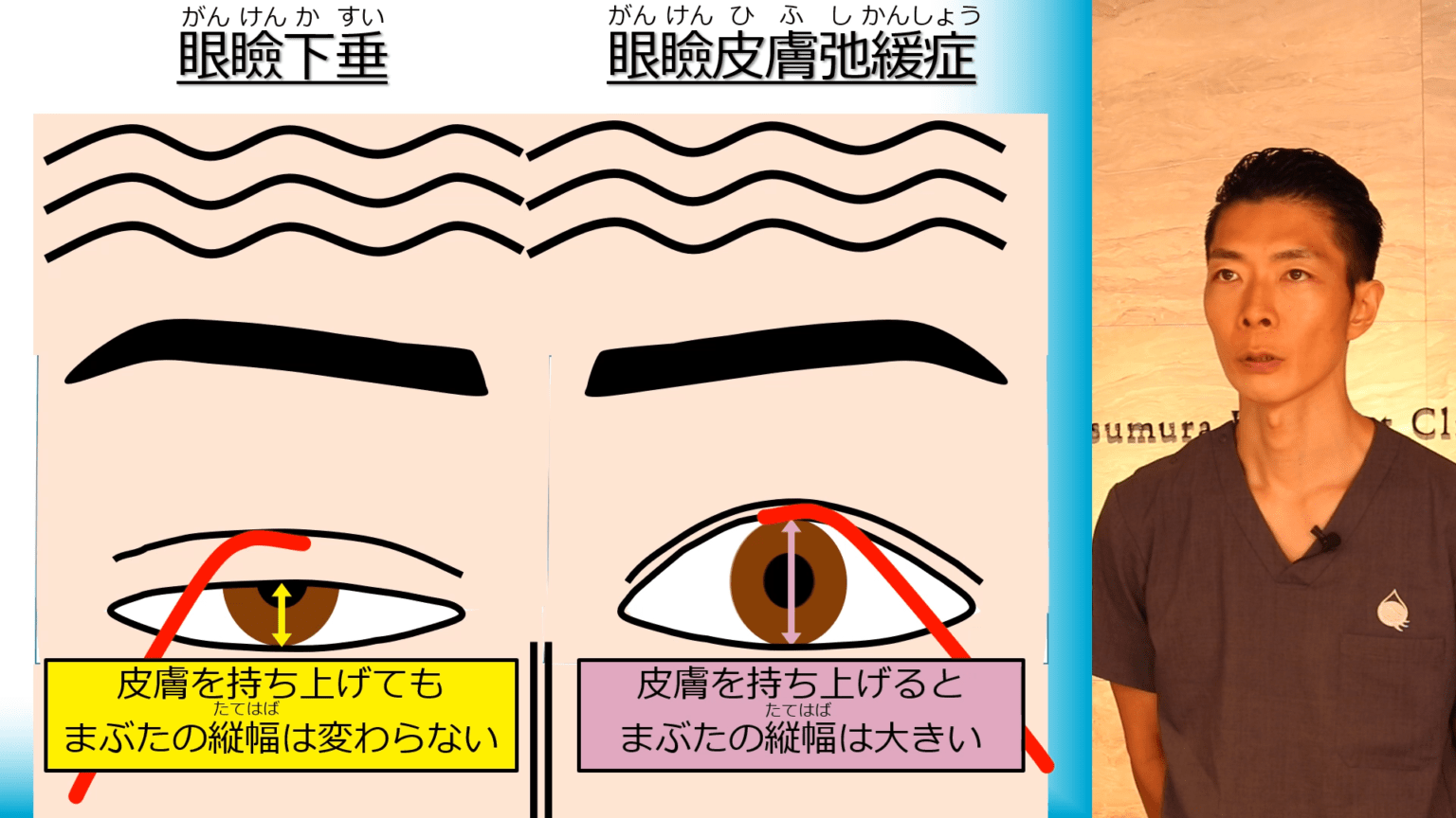 眼瞼皮膚弛緩症とは _ 眼瞼皮膚弛緩症 写真 – UDMETF