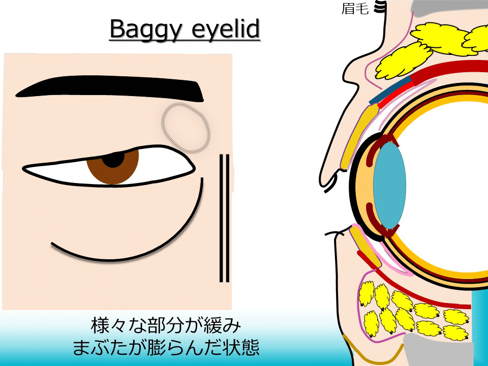 Baggy eyelid