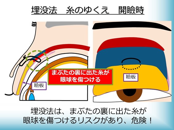 埋没法 糸のゆくえ 開瞼時