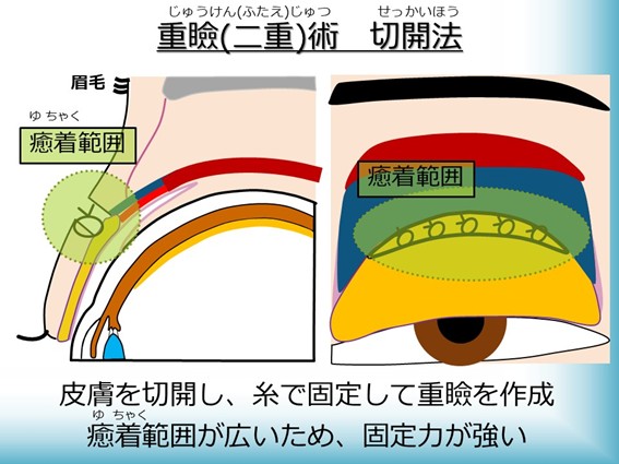 重瞼（二重）術 切開法