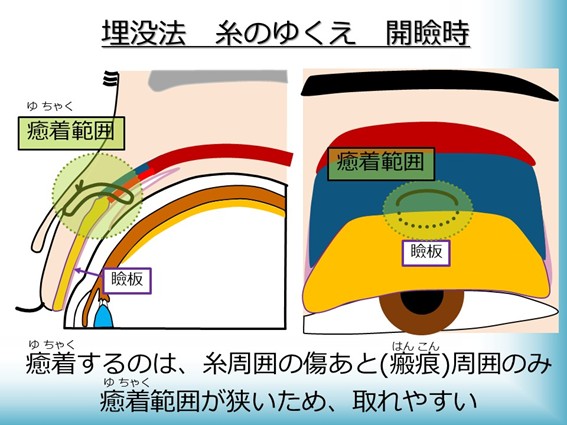 埋没法 糸のゆくえ 開瞼時