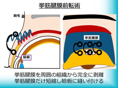 挙筋腱膜前転術