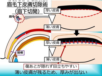 眉毛化皮膚切除術（眉下切開）