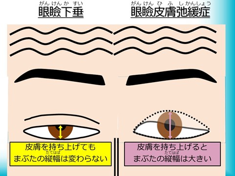眼瞼下垂と眼瞼皮膚弛緩症