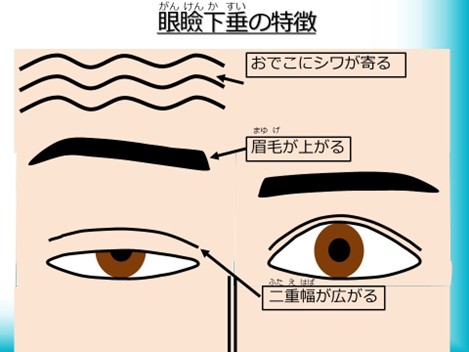 眼瞼下垂の特徴