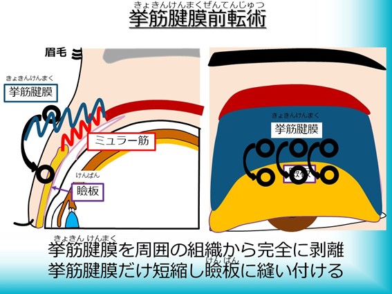 挙筋腱膜前転術