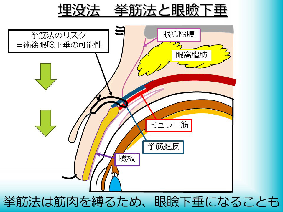 埋没法 挙筋法と眼瞼下垂