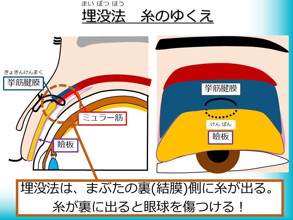 埋没法 糸のゆくえ
