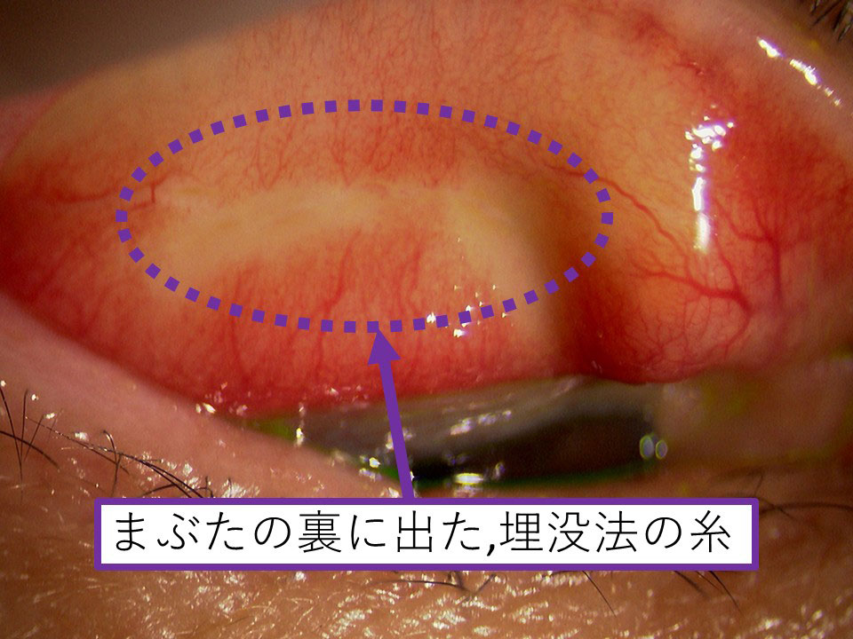 まぶたの裏に出た埋没法の糸