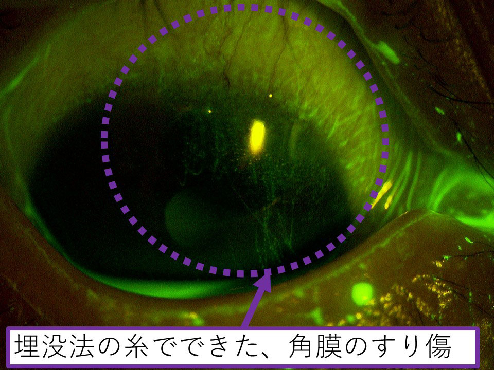 埋没法の糸でできた角膜のすり傷