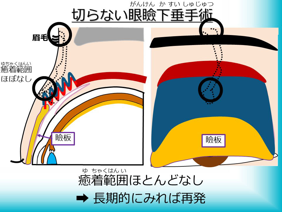 切らない眼瞼下垂手術