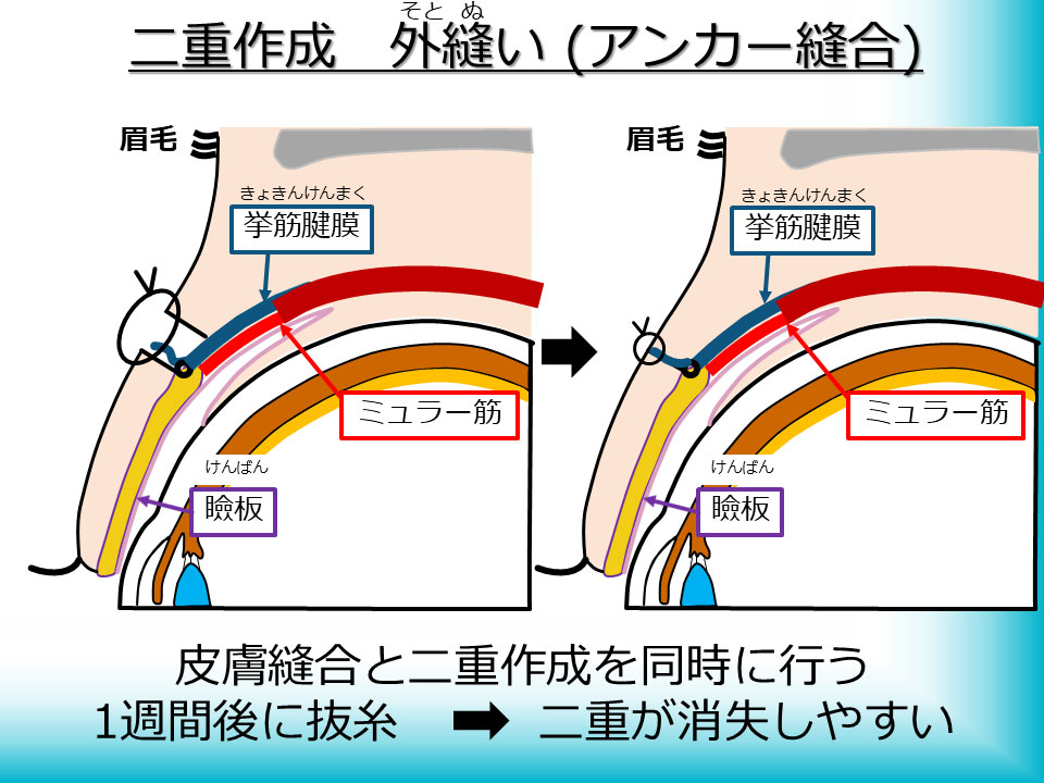 二重作成 外縫い(アンカー縫合)