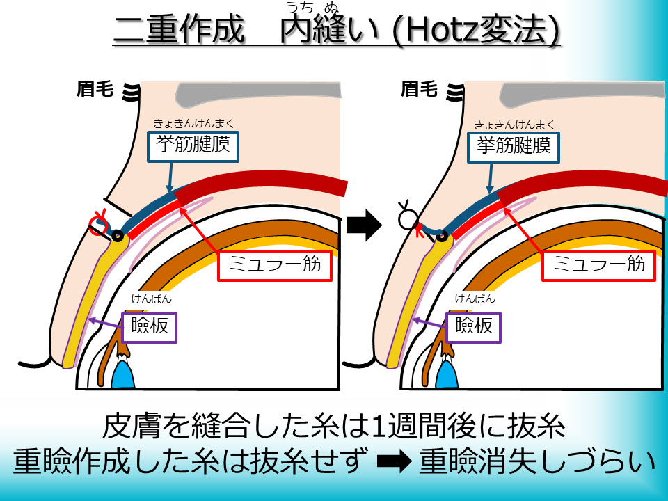 二重作成 内縫い(Hotz縫合)