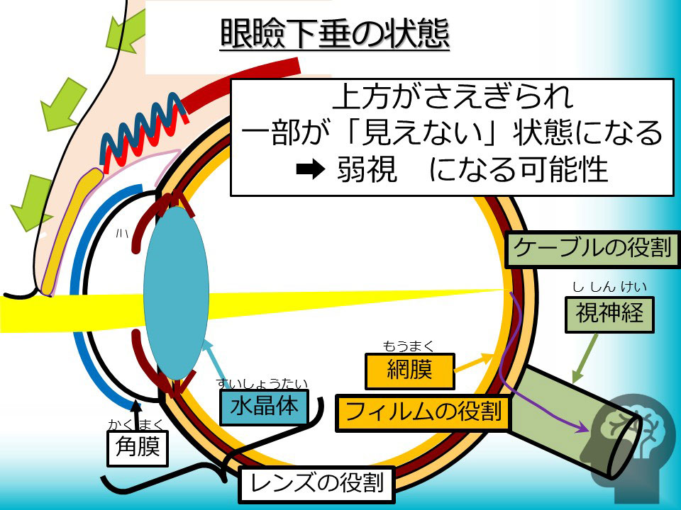 眼瞼下垂の状態