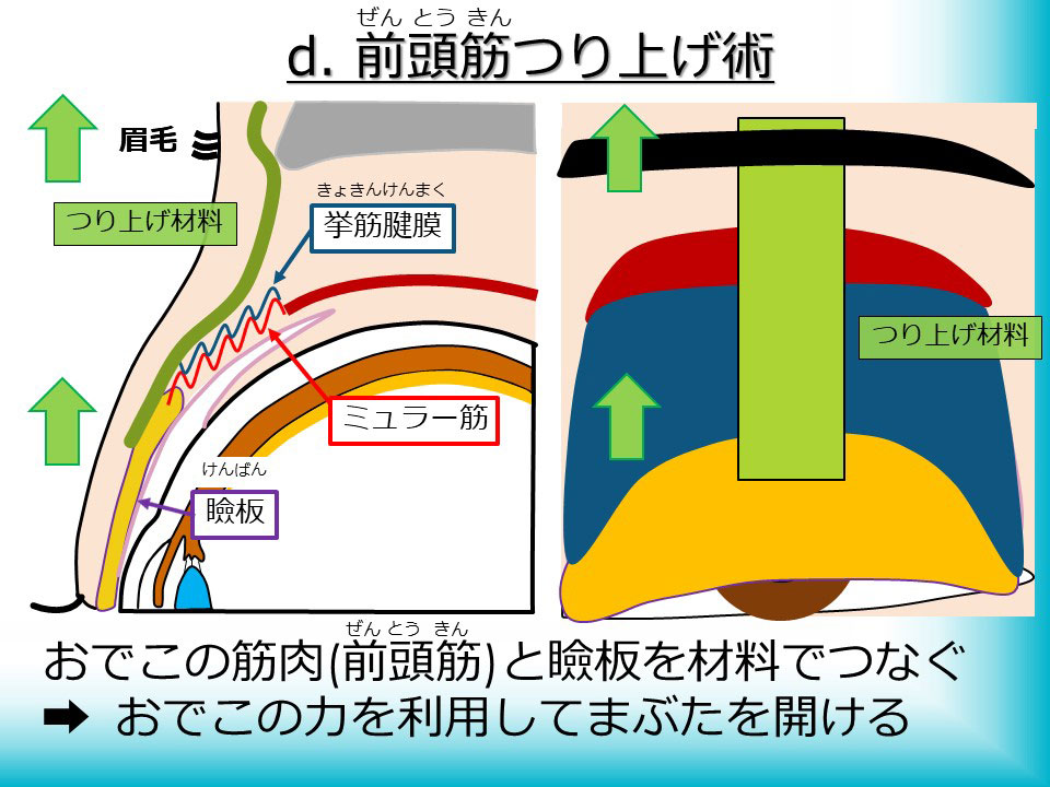 前頭筋つり上げ術