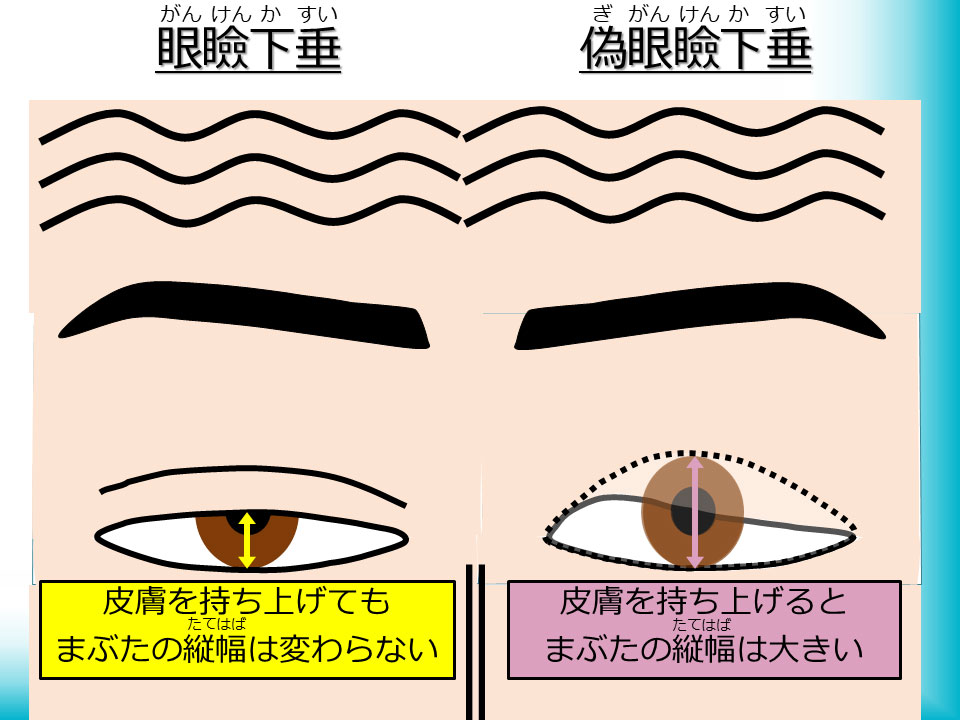 眼瞼下垂と偽眼瞼下垂