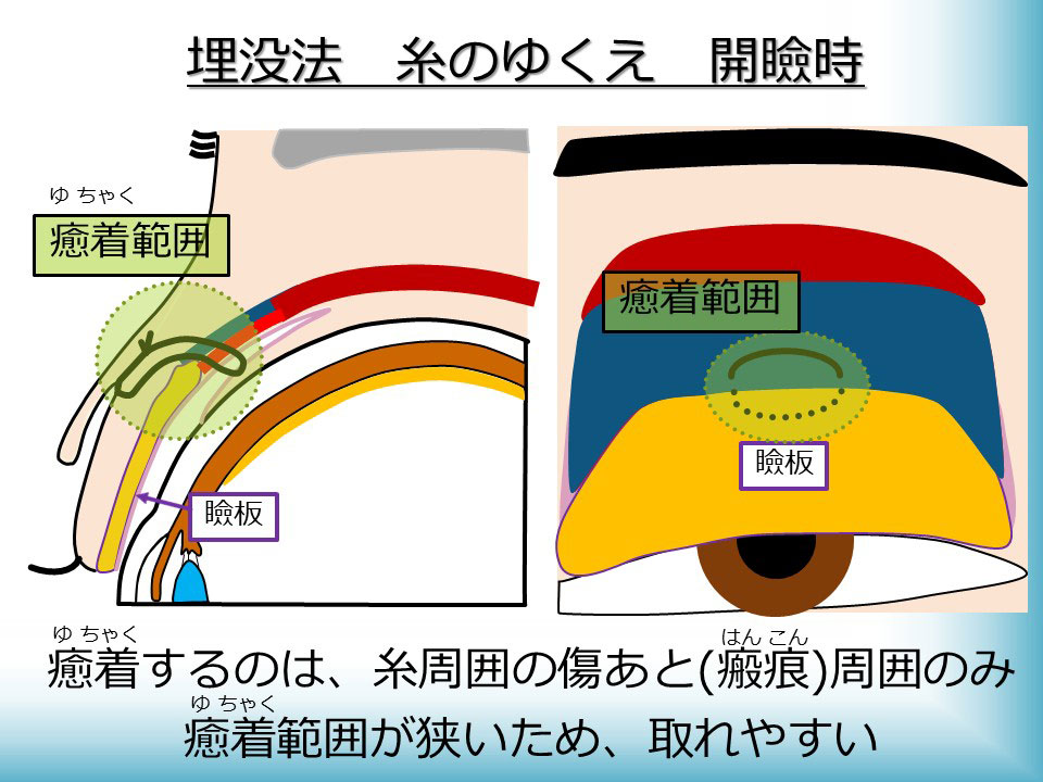 埋没法 糸のゆくえ 開瞼時