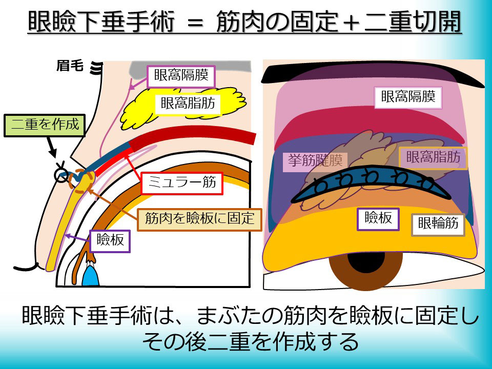 眼瞼下垂手術＝筋肉の固定＋二重切開