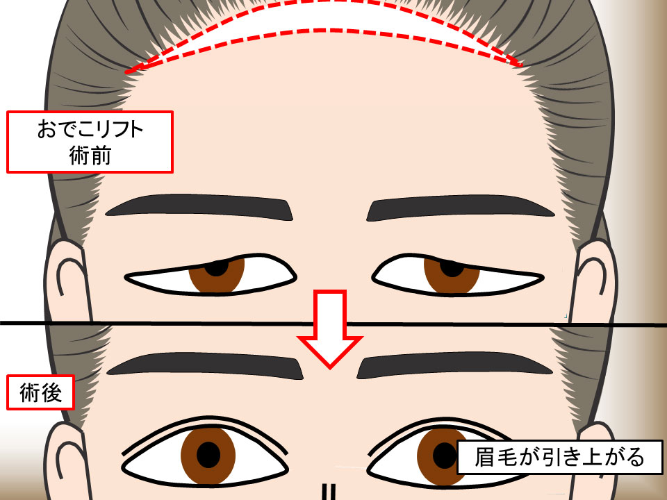 おでこリフトの施術前・術後