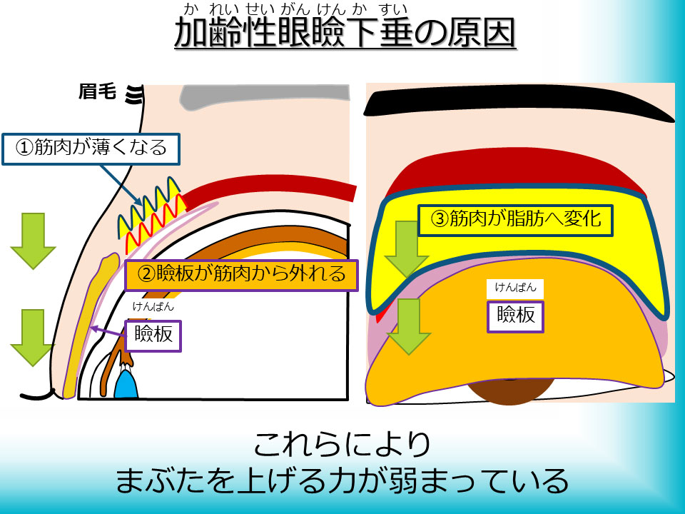 加齢性眼瞼下垂の原因