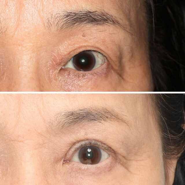 まぶたのたるみは眼瞼下垂手術・眉下切開のどちらを選ぶべき？脂肪取り（ROOF・眼窩脂肪）の重要性まで徹底解説
