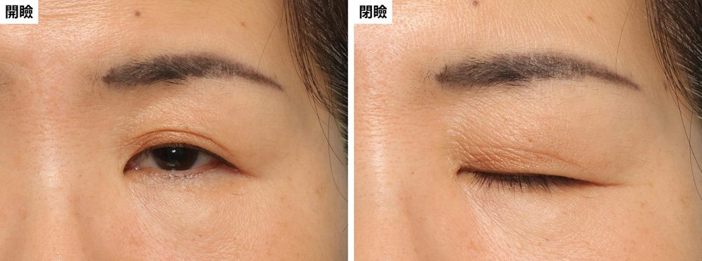 まぶたが厚く、眼瞼下垂と皮膚のたるみの両方があった場合