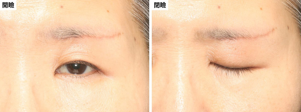 眉下切開後・眼瞼下垂手術前