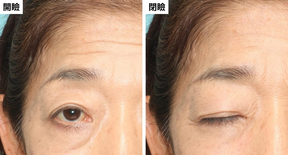 おでこの力で目を開けており、おでこのシワが深くなっていた場合
