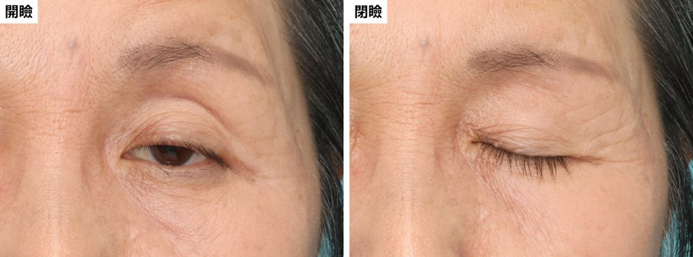 白内障手術のあと、まぶたの下がりが気になり始めた場合