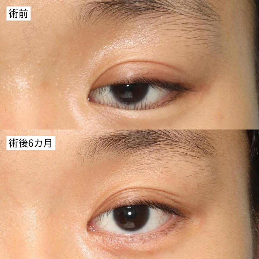 術後の経過