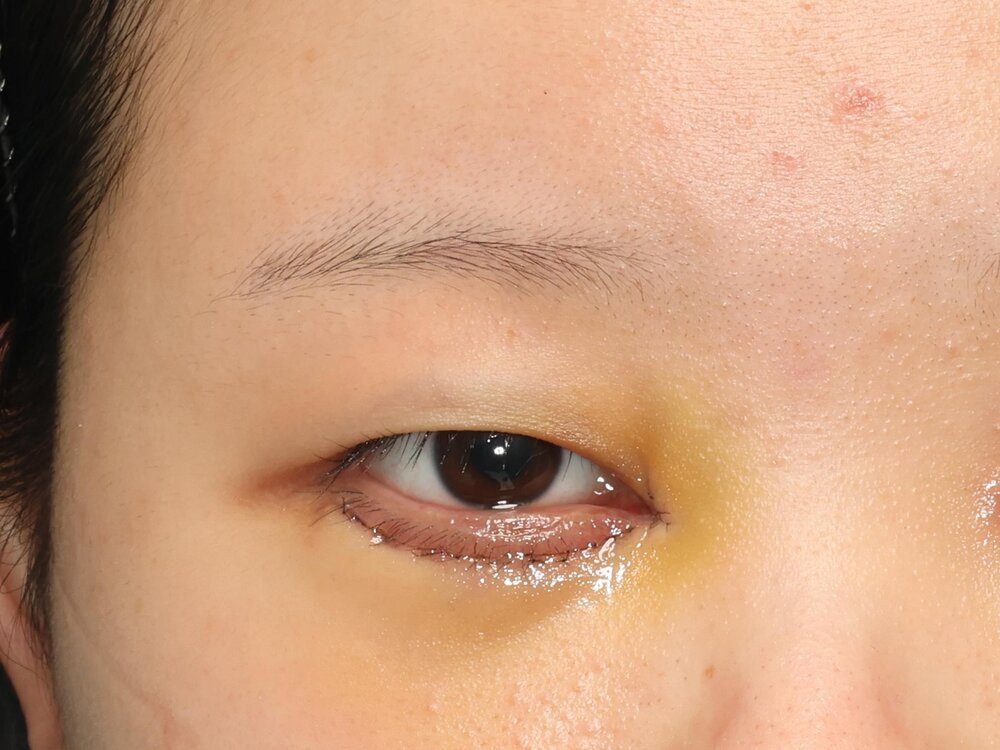 下まぶたの手術後1週間