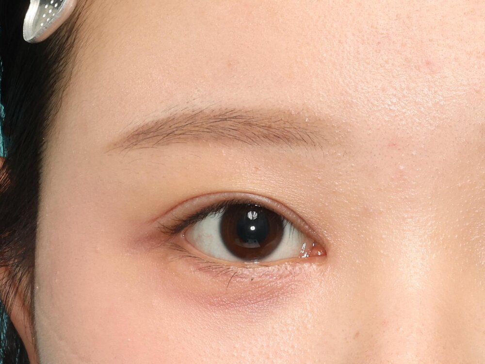 上まぶたの手術後3カ月(下まぶたの手術後4カ月)