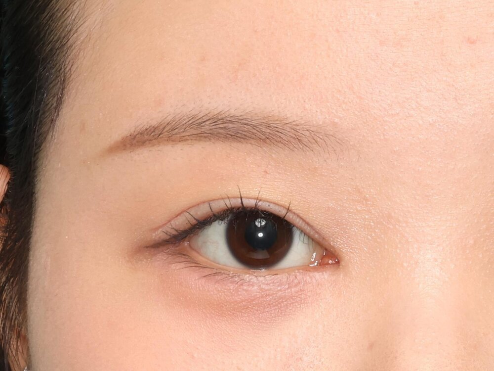上まぶたの手術後6カ月(下まぶたの手術後7カ月)