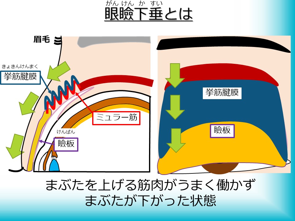 眼瞼下垂とは
