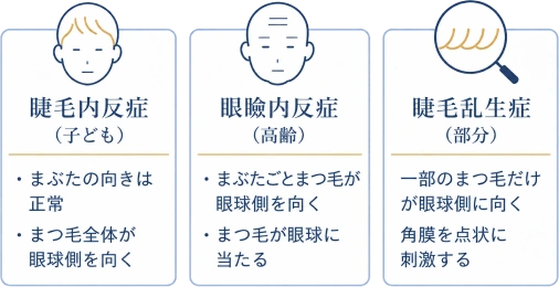 逆さまつげの3つの種類の比較図。睫毛内反症（子ども）はまぶたの向きは正常でまつ毛全体が眼球側を向く。眼瞼内反症（高齢）はまぶたとまつ毛が眼球側を向き、まつ毛が眼球に当たる。睫毛乱生症（部分）は一部のまつ毛だけが眼球側に向き、角膜を点状に刺激する。
