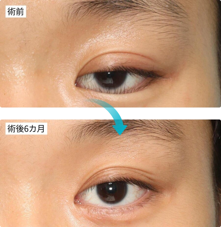 10代後半・両下Hotz変法と内眥形成（目頭切開）の術前・術後6カ月の比較写真