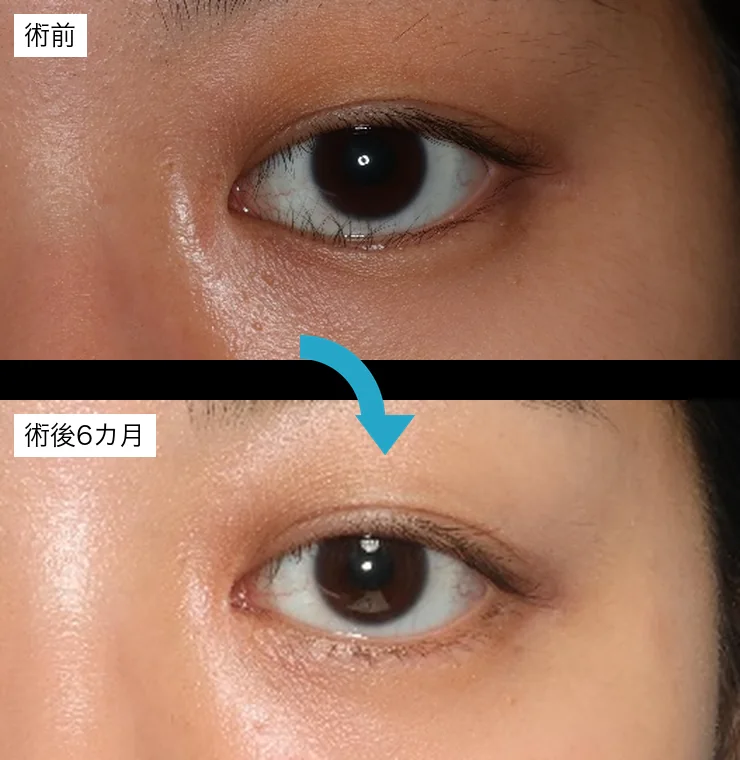 20代後半・両下Hotz変法と内眥形成（目頭切開）の術前・術後6カ月の比較写真（左目）