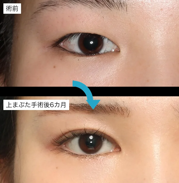10代後半・下まぶたのHotz変法と内眥形成の後に、上まぶたの逆さまつげ手術と眼瞼下垂手術を行った術前・上まぶた手術後6カ月の比較写真（右目）