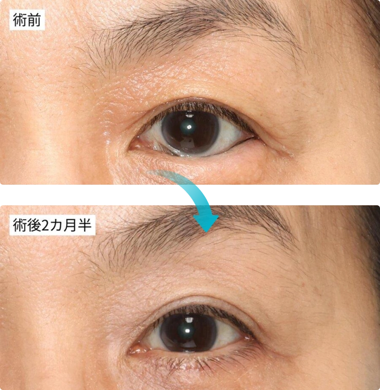 Jones変法の図解。下まぶたの筋肉（LER）を周囲から剥離して短縮し、瞼板に縫い付ける