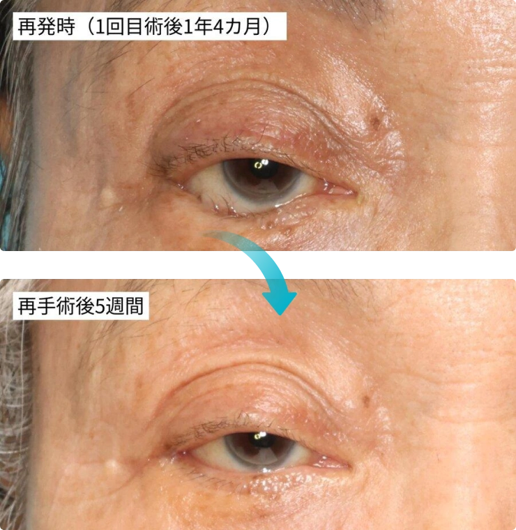 Lateral Tarsal Strip（LTS）の図解。ゆるんだ外眥靱帯を切断し、瞼板を骨膜と縫い付ける
