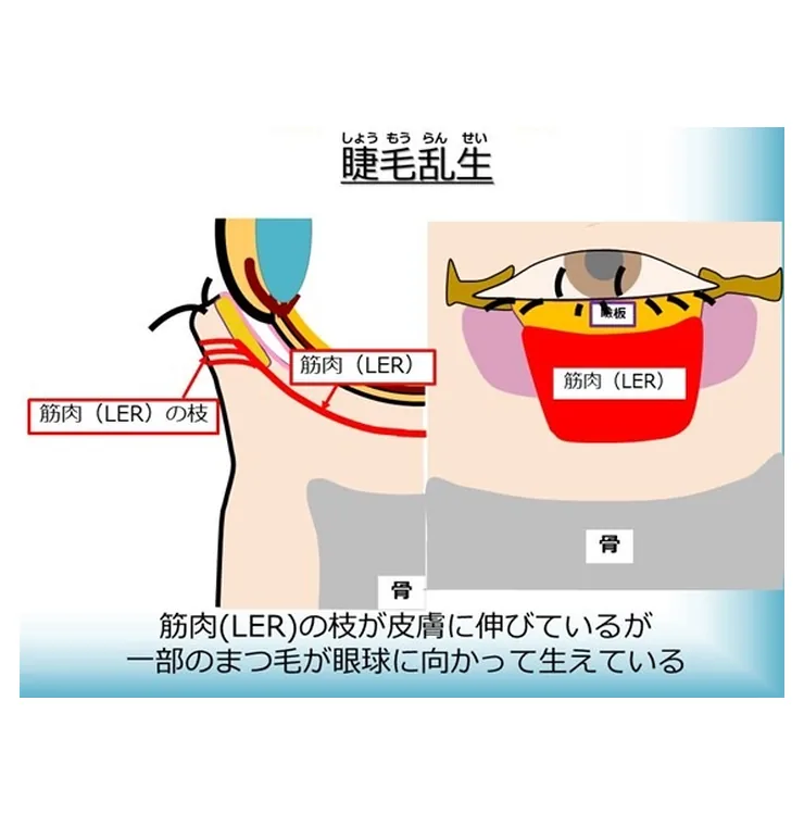 睫毛乱生の図解。まつげを外に向ける筋肉（LER）の枝は皮膚に伸びているが、一部のまつげが眼球に向かって生えている