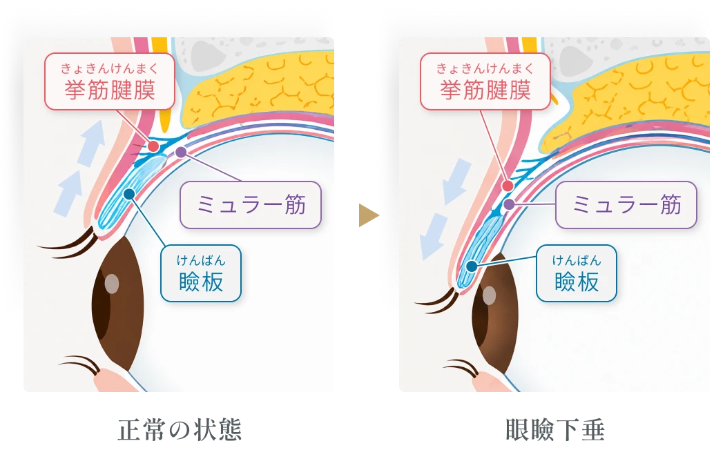 正常な状態と眼瞼下垂の状態を比較した目もとの断面図。正常の状態では挙筋腱膜とミュラー筋がまぶたを引き上げているが、眼瞼下垂の状態ではこれらが緩み、まぶたが下がっている。
